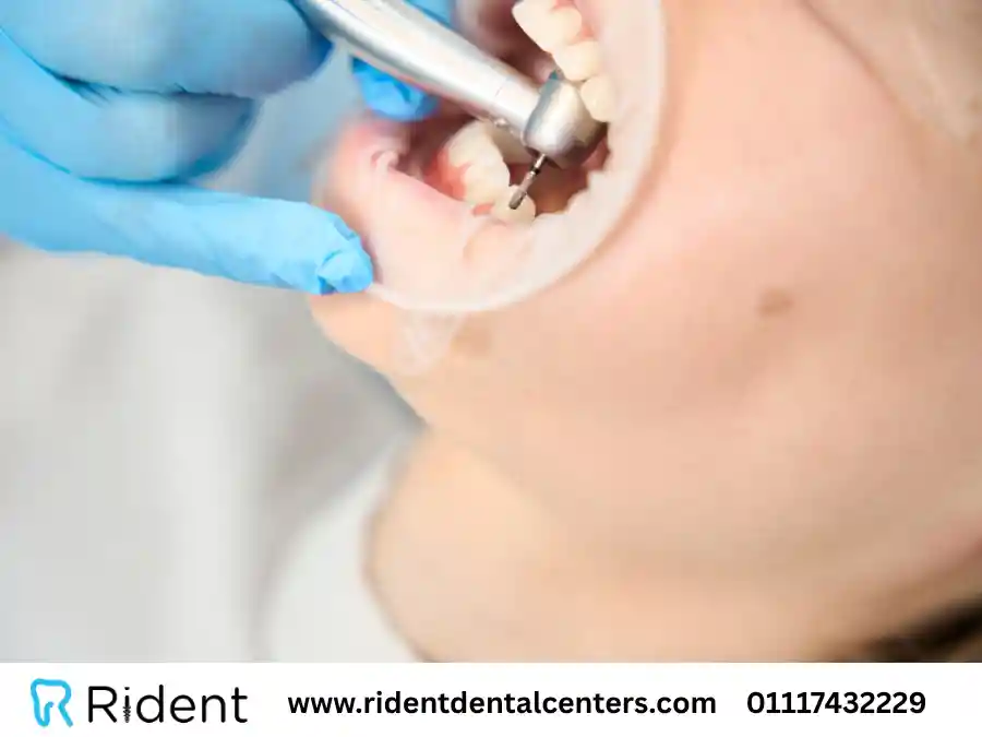 تخلص من تسوس الاسنان في يوم واحد نهائياً بـ 3 خطوات